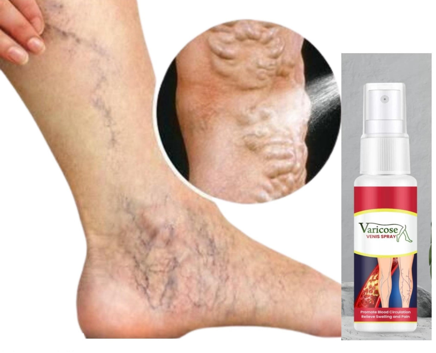 Varcose Venis Spray (Pack of 1)
