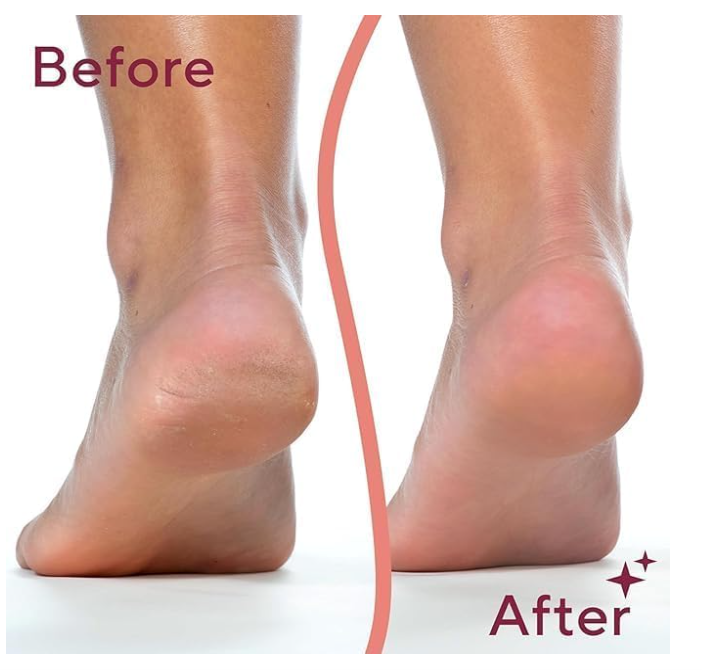 callus remover for feet dead skin remover pedicure tools Callus Remover Hard and Dead Skin Remover Electric Foot Callus Remover Rechargeable Pedicure Tool.